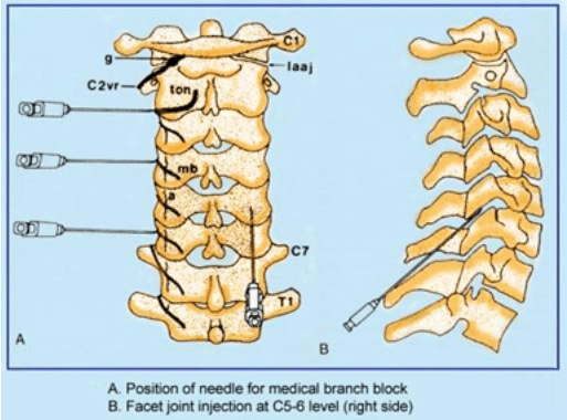 Cervical Medial Branch Block Nerve And Pain Institute